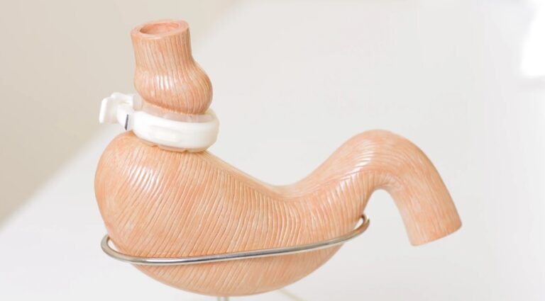 for Lap Band Surgery